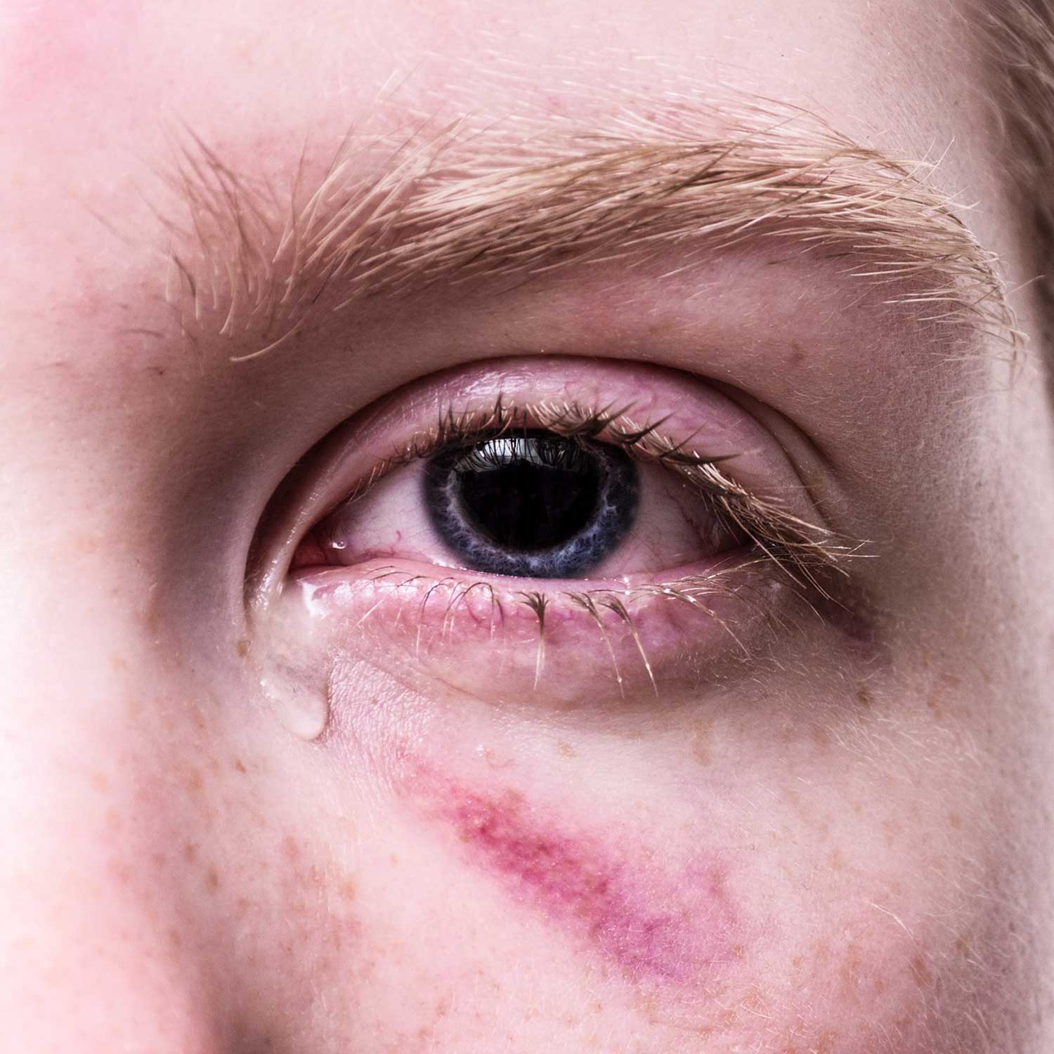 Wie Kann Man Rote Augen Vortäuschen
