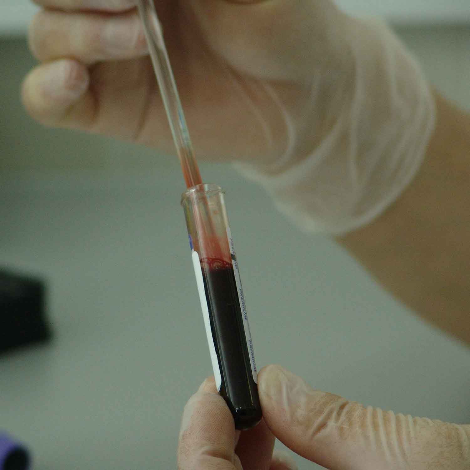 Wie ist Aids entstanden Entstehung, Ursachen und Entwicklung