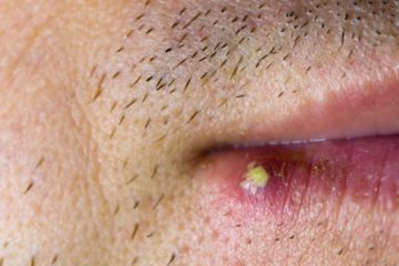 Mitesser Auf Der Lippe