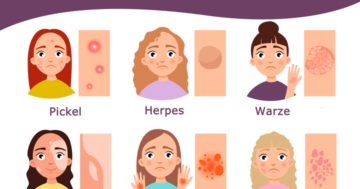 Unterschied zwischen Warze, Flechte, Akne, Pickel, Mitesser, Plaque und Herpes